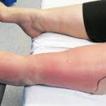 Cellulitis: How long does it take to heal on legs?