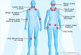 Fibromyalgia Tender Points: What and Where Are They?