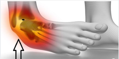 Fibromyalgie : pourquoi mes pieds me font-ils mal ?